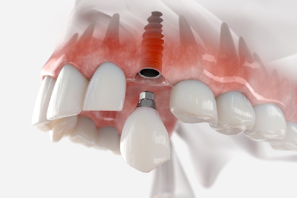 Imagen de un implante dental