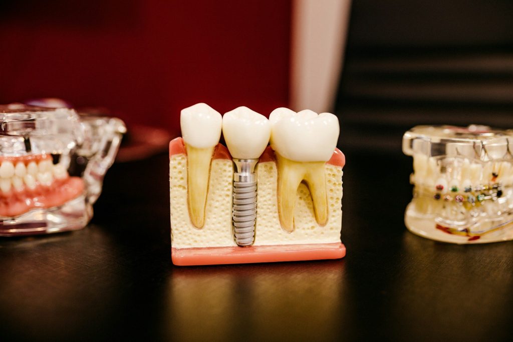dental implant model with teeth